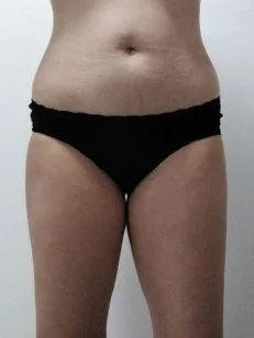 Before Endermologie treatment