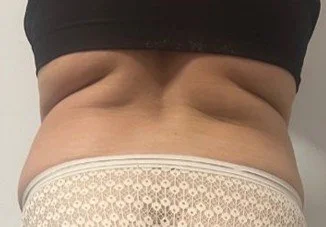 Before Endermologie treatment