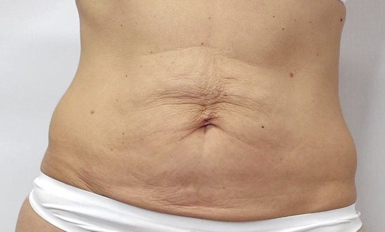 Before Endermologie treatment