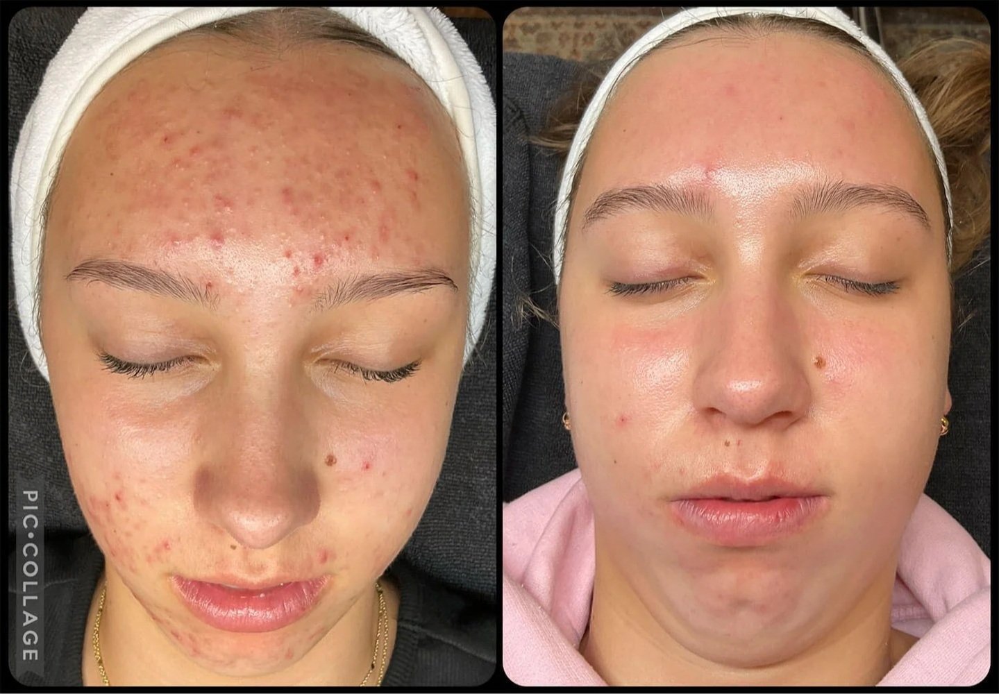 Emily-R.-Aviclear_Acne-facials.jpg