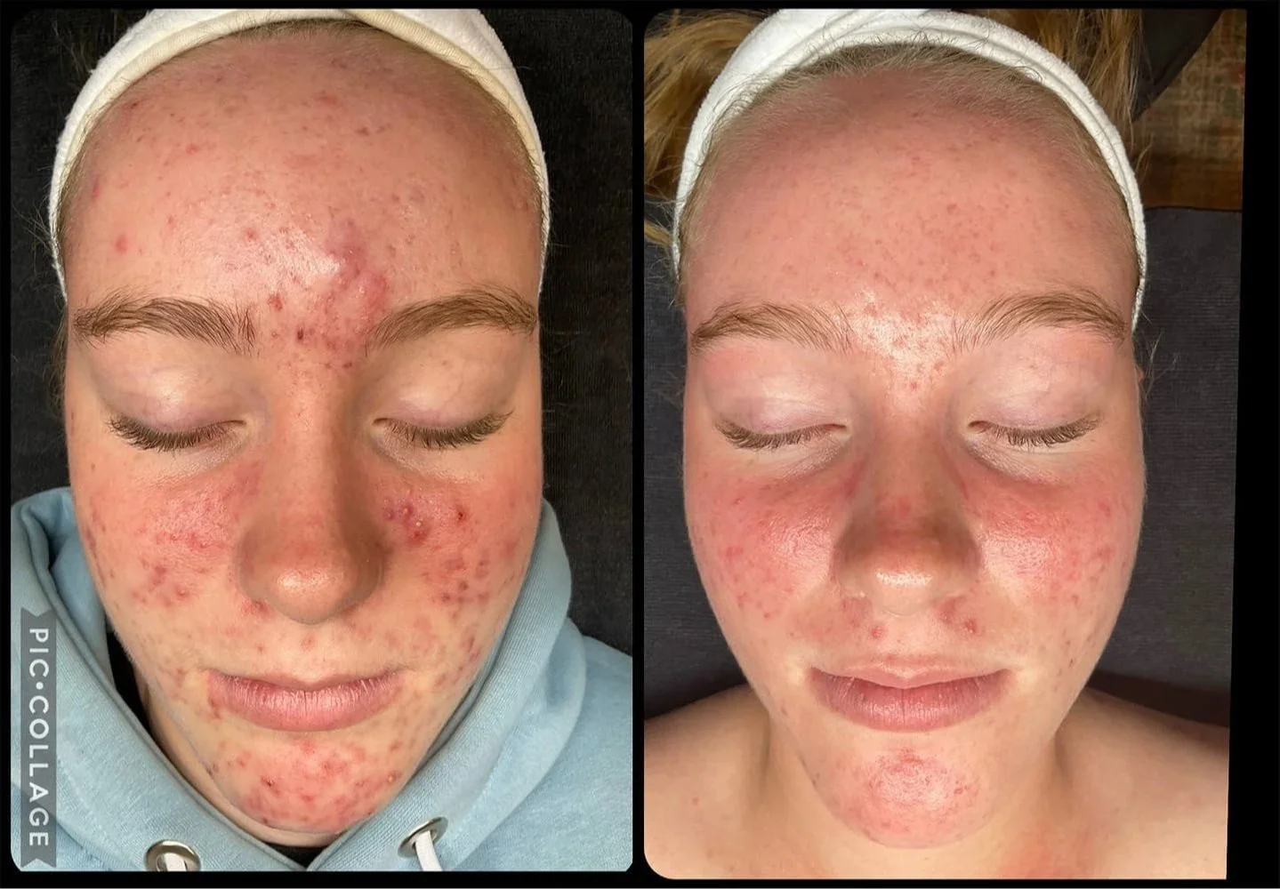 Andie-R.-Aviclear_24-week-Acne-Academy.jpg