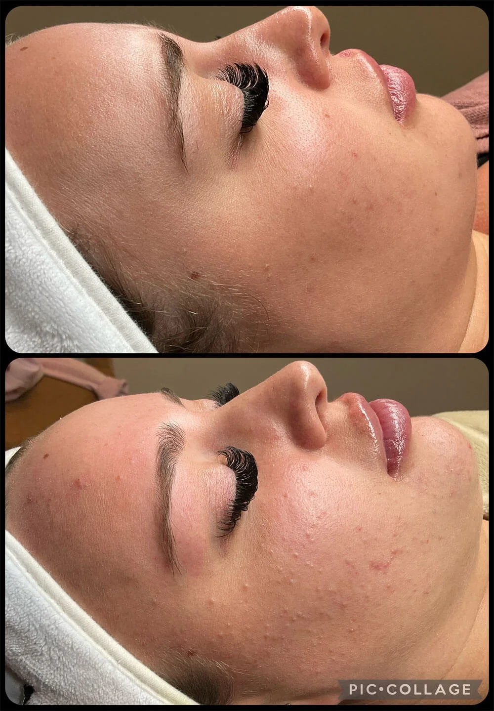 B&A-Morgyn-K.-18-week-acne-academy.jpg