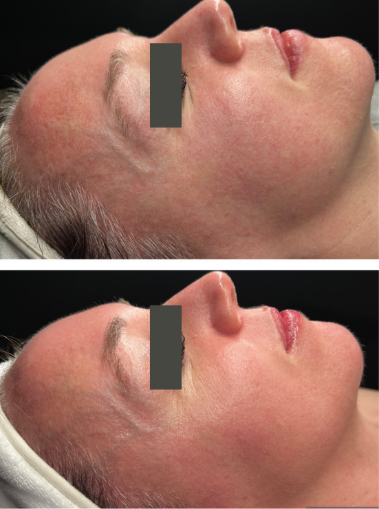 The Magic of Microneedling (1).png