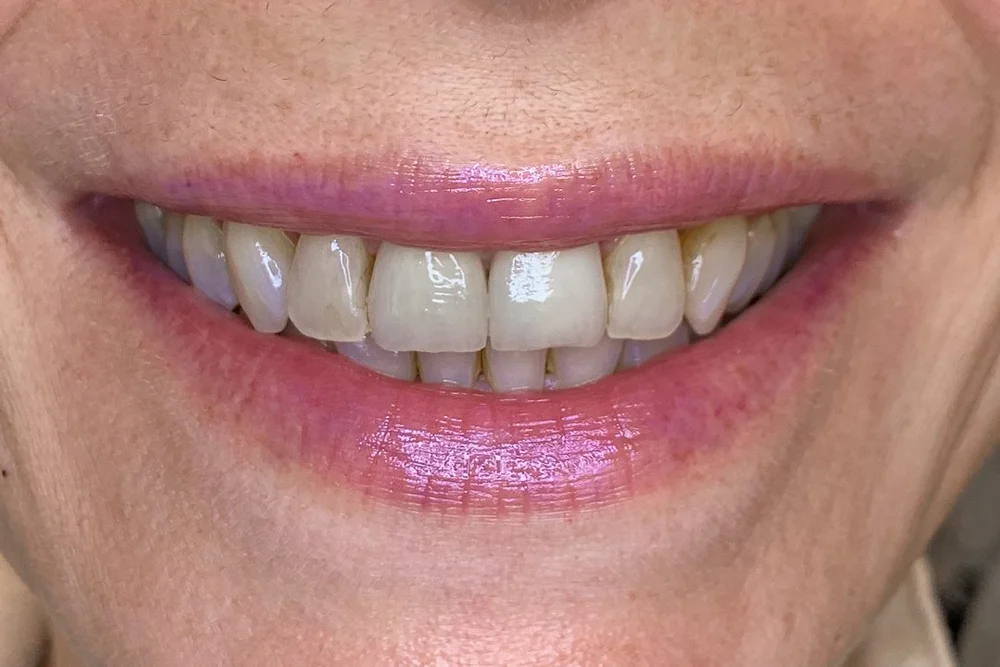 before-and-after-smile-makeovers-veneerlab-dental-aesthetics