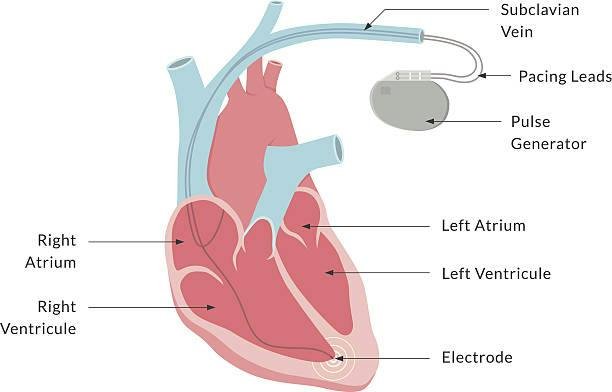 How do Pacemakers work? — Learn how Gadgets Work - One Gadget at a Time