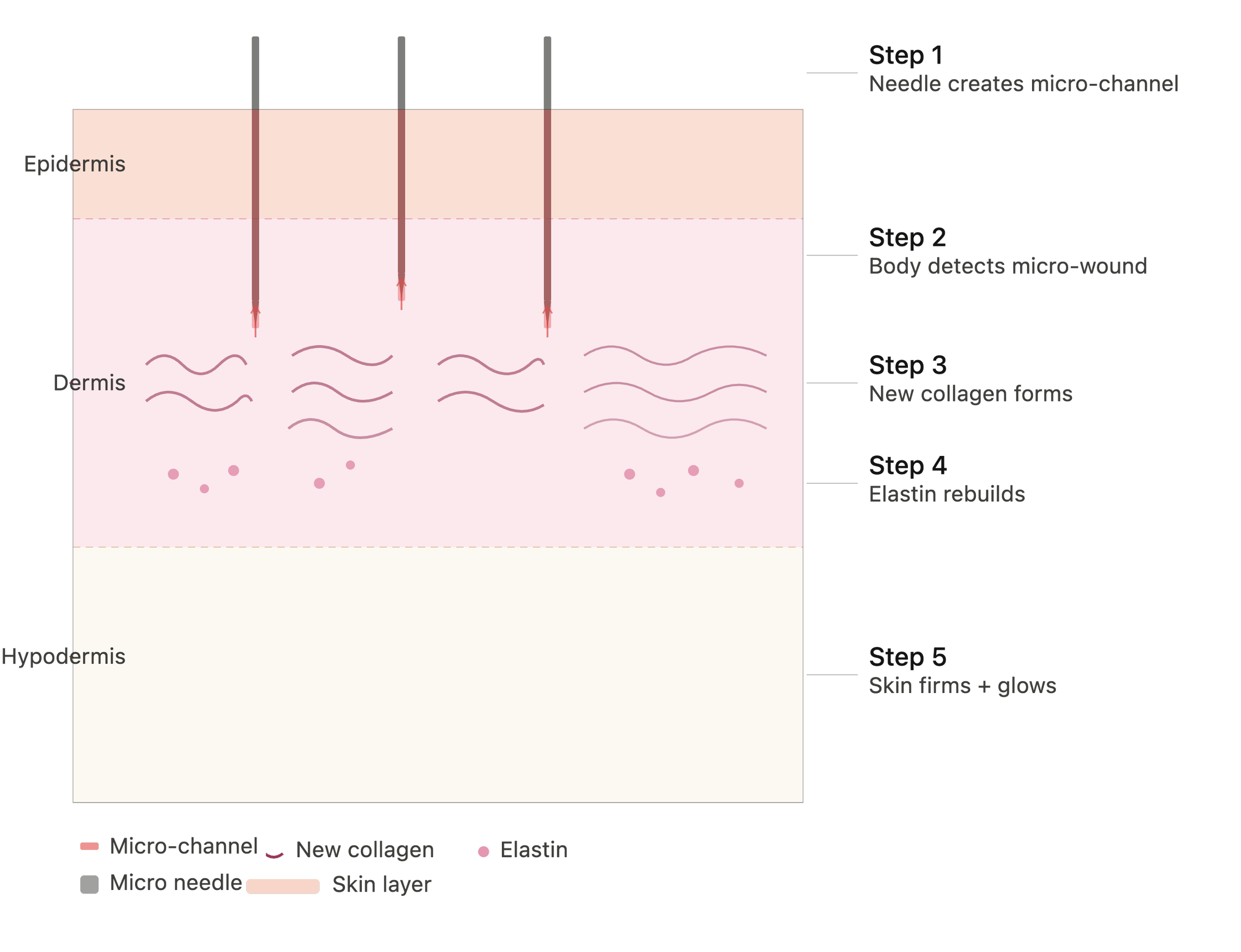 Micro-Needling Collagen Induction Therapy