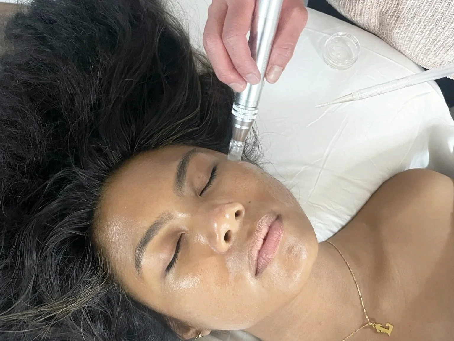 A woman lying down with her eyes closed while a practitioner uses a microneedling with serum cosmetic or medical procedure.