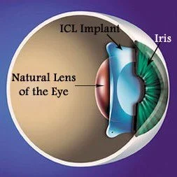 ICL Implant in between Iris and Natural Lens of the Eye