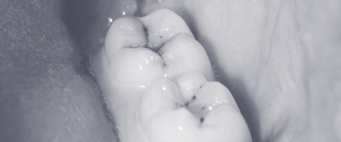Close-up of a molar tooth in mouth, showing dental anatomy.