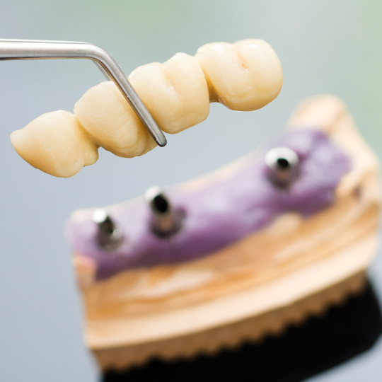 Dental Bridges replace missing teeth. 