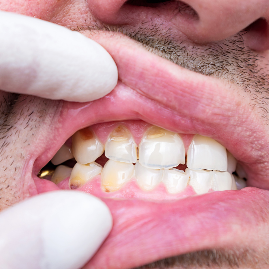Dentist examining patient's mouth with dental tools.