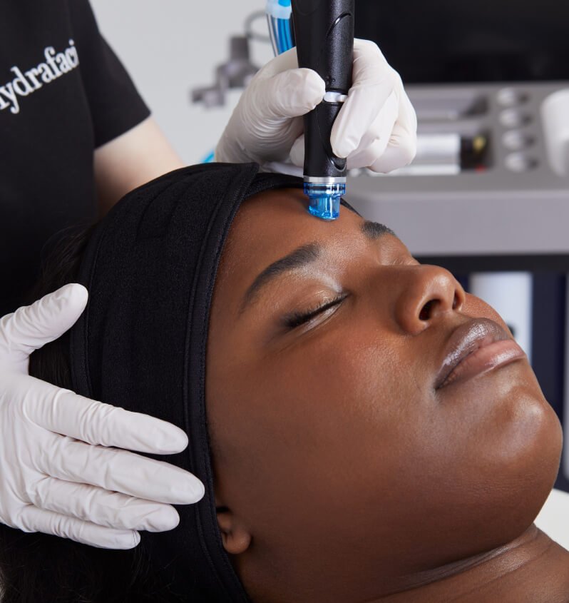 hydrafacial acne treatment Libertyville, Illinois
