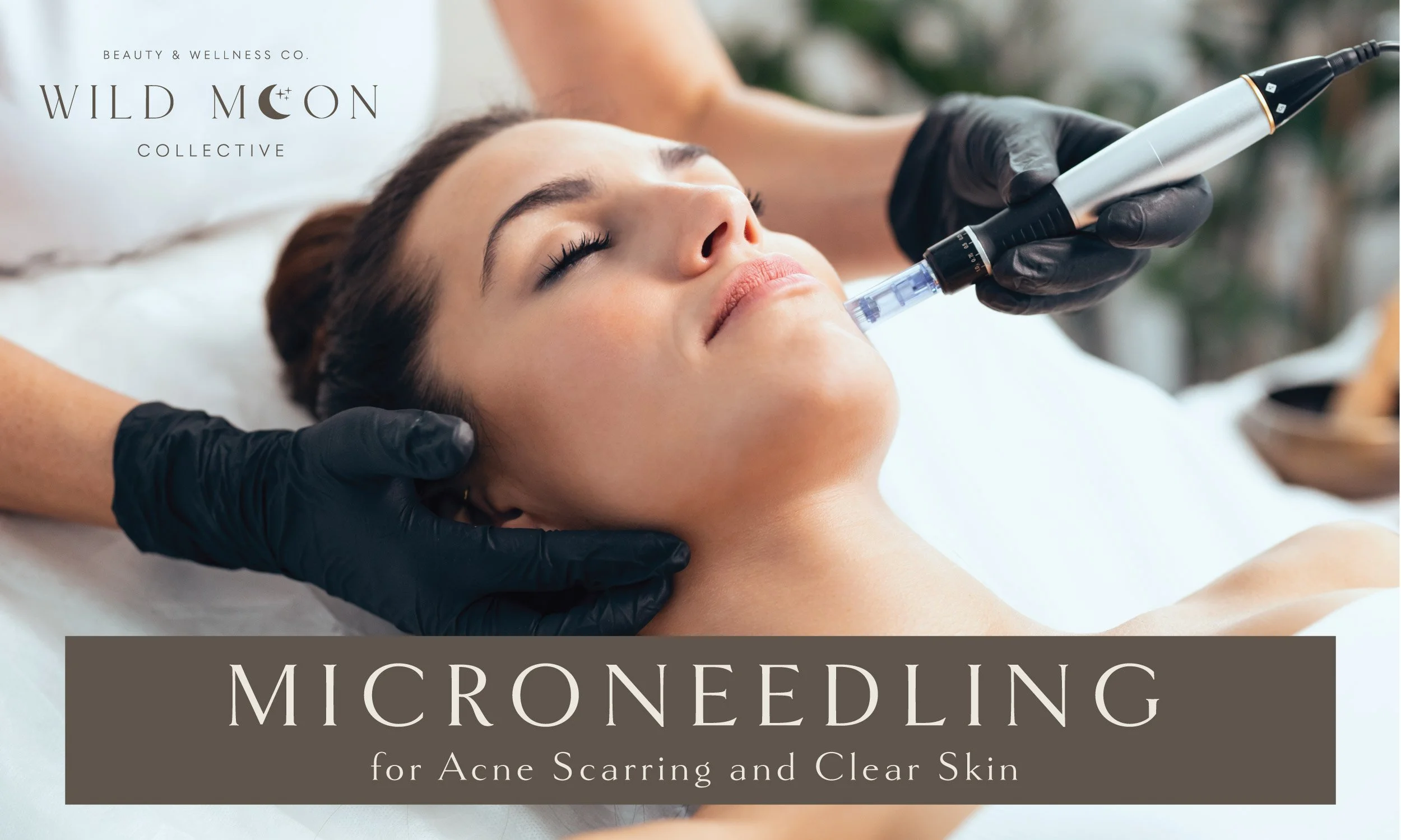 How to Beat Acne: Microneedling for Clear Skin and Scar Treatment