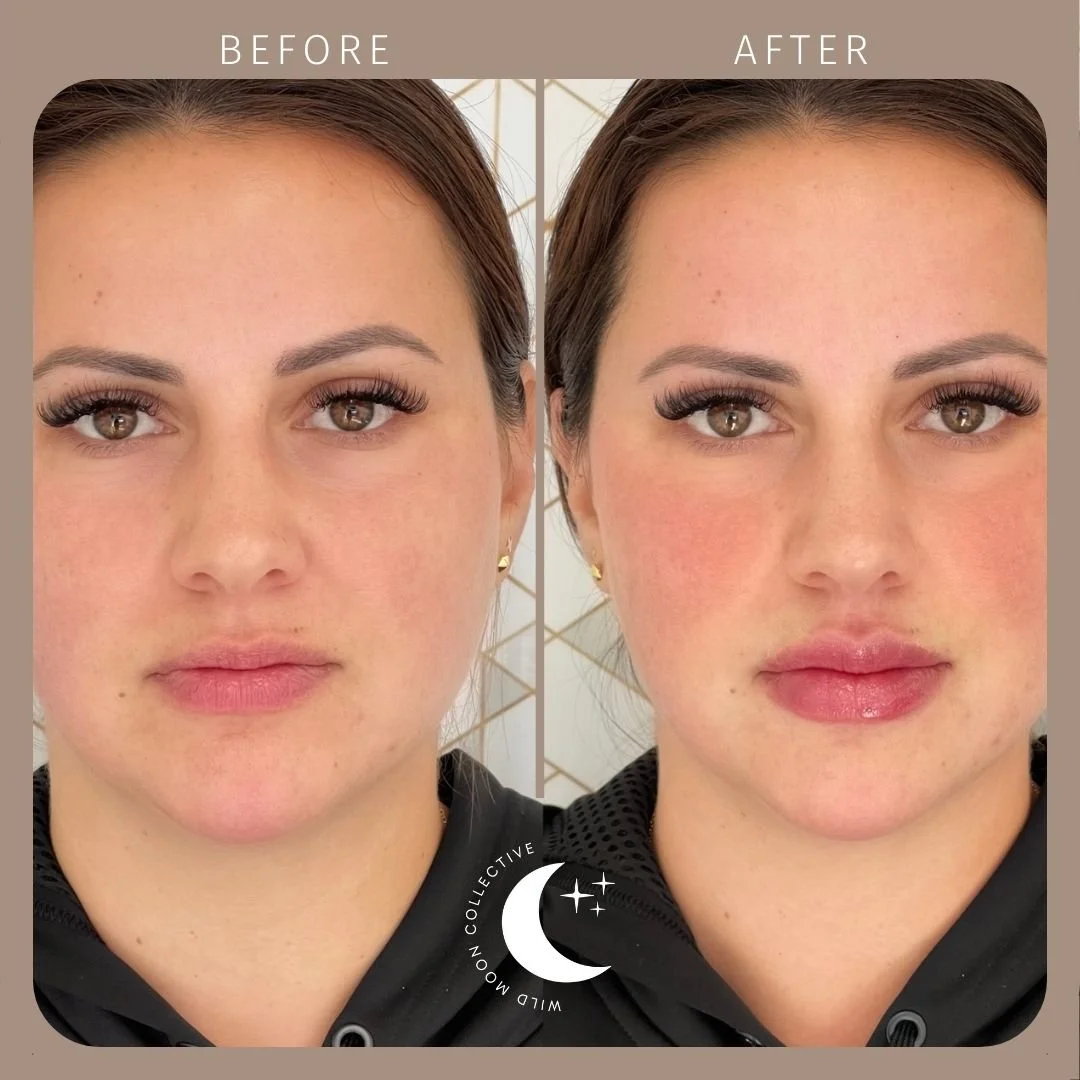 Before & Afters Fillers & Lip Injections Libertyville, IL Wild Moon