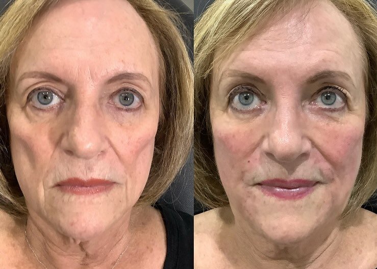 You can look younger and better at any age! 🔥🔥🔥 
Adding a little filler in the right places, can make the biggest difference, while still looking natural! 

Buy two syringes at regular price, get one FREE continues till the end of the month! ($700