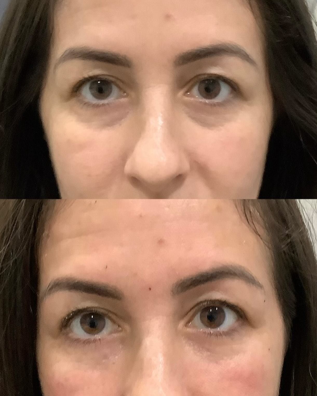 Adding a little volume to the tear trough area can take years off the face! It also can make a young mom look less tired, even when she is! 😂 One syringe Restylane used! 

#restylane #galdermaaesthetics #teartrough #teartroughfillers #odessafl #mynt