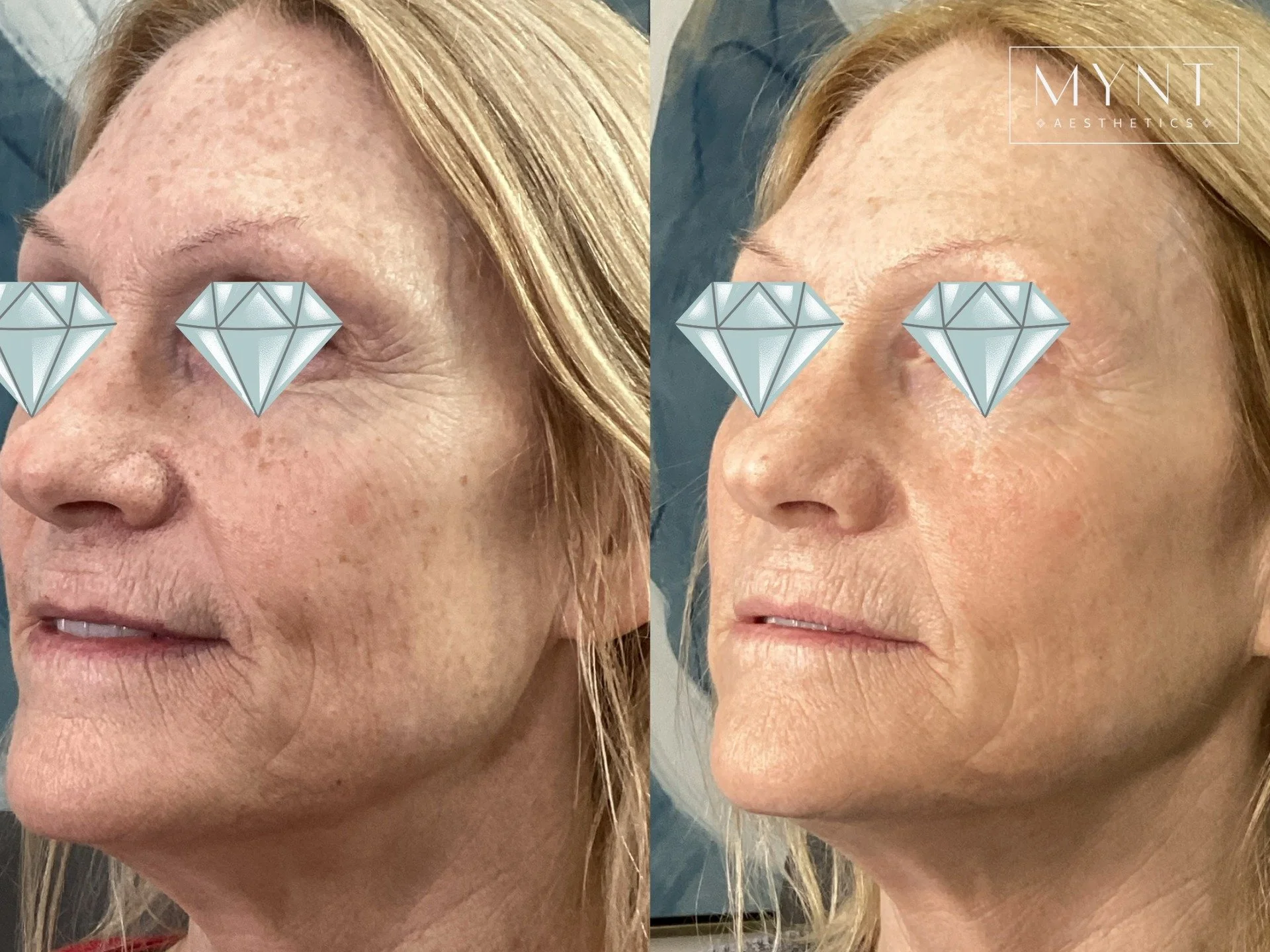 ✨HALO + BBL are the ultimate skin rejuvenation duo✨

When it comes to achieving real, visible skin transformation, it's not about doing one treatment doing everything. It's about pairing the right treatments to address multiple layers of the skin at 