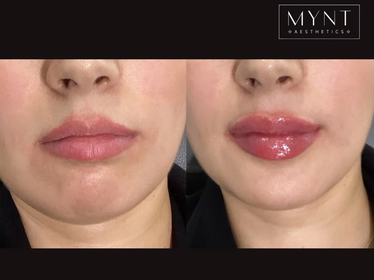 Soft, balanced, and beautifully enhanced 💋

Lip filler by @carlacole_np 💉 Just in time for Valentine&rsquo;s Day❤️&zwj;🔥

Call today or go online and book your appointment!

📲 813-498-9563
⛓️&zwj;💥Link in Bio 
📍23107 Tabak Lane Land O&rsquo; La