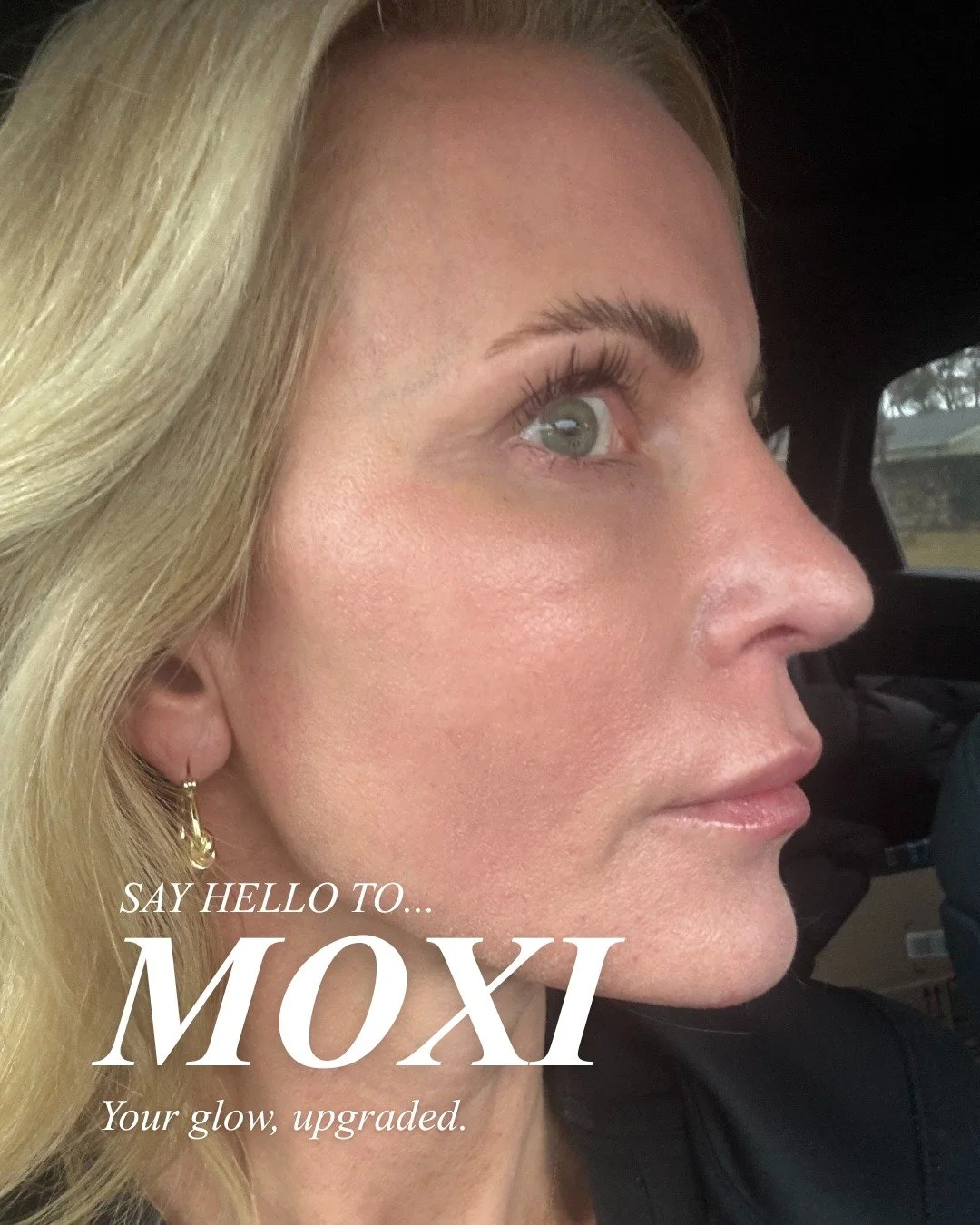✨NEW AT MYNT✨
We are so excited to officially introduce MOXI !! Our newest laser treatment designed to refresh, brighten, and bring out your best skin.

MOXI is perfect for anyone wanting that effortless glow with minimal downtime. Think smoother tex