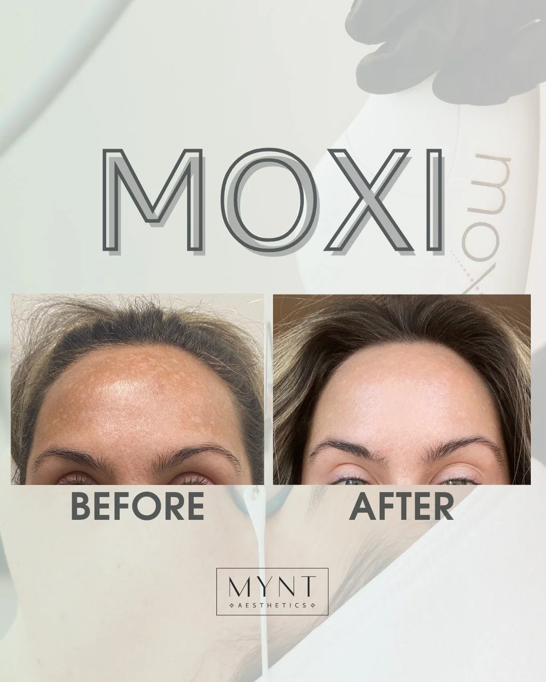 ✨ MOXI Laser Skin Rejuvenation ✨

This before &amp; after highlights the power of MOXI for improving sun damage, uneven pigmentation, and overall skin texture.

MOXI is a gentle, non-ablative fractional laser designed to stimulate collagen production