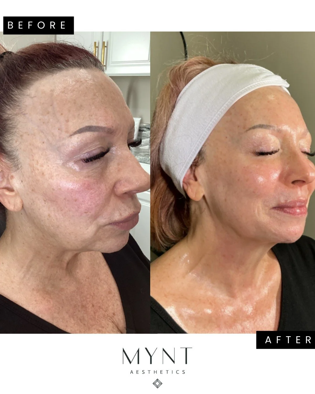 ✨ GLOW UP IN PROGRESS ✨

This beauty came in ready for a full skin refresh &mdash; and the results speak for themselves! 🔥

For this transformation, we combined multiple advanced treatments to target pigmentation, texture, fine lines, and overall ra