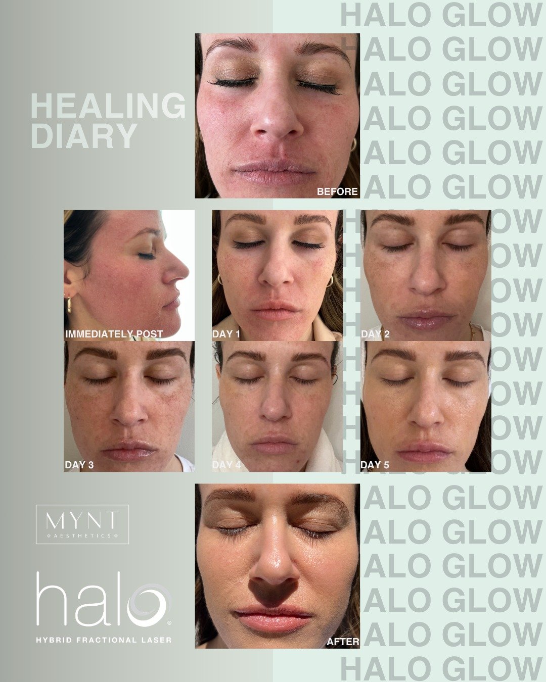 ✨ HEALING DIARY: THE HALO GLOW ✨

At MYNT Aesthetics, we believe education is just as important as results. Here&rsquo;s a real-time look at the healing journey after a HALO&reg; Hybrid Fractional Laser treatment &mdash; so you know exactly what to e