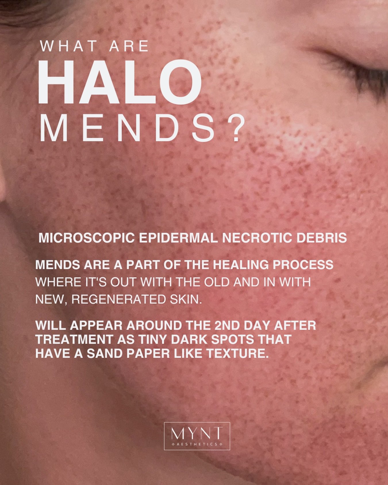 After your HALO treatment, you may notice tiny dark spots appearing around day 2. These spots have a sandpaper-like texture and are completely normal &mdash; this process is known as MENDS.

We like to call it &ldquo;peppering&rdquo; because of the s