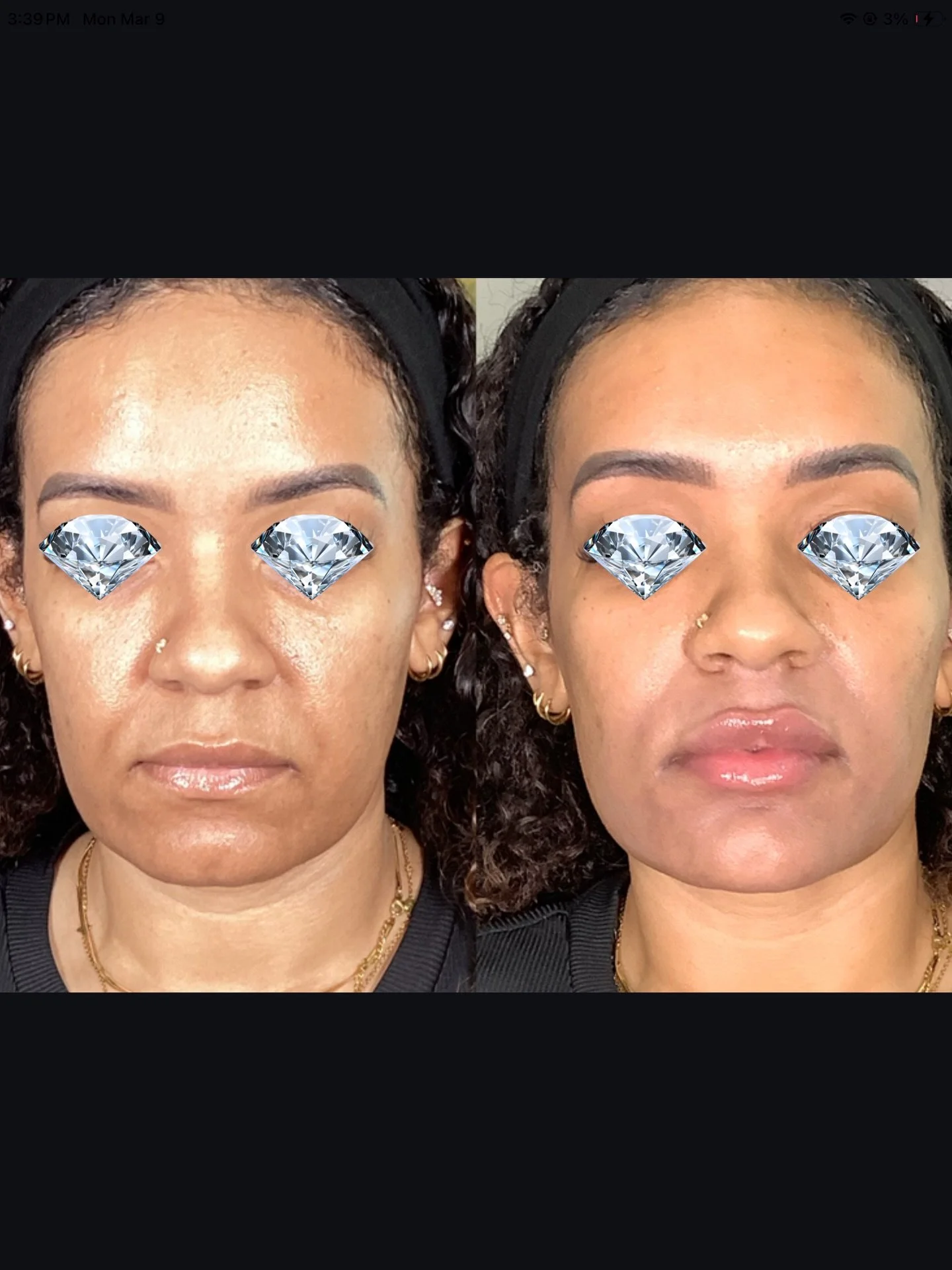 This is the power of facial balancing💉

Instead of treating just one area, we enhanced multiple features. Lips, chin, marionette lines, and nasolabial folds&hellip; to bring everything into proportion. The goal isn&rsquo;t to look &ldquo;done&rdquo;