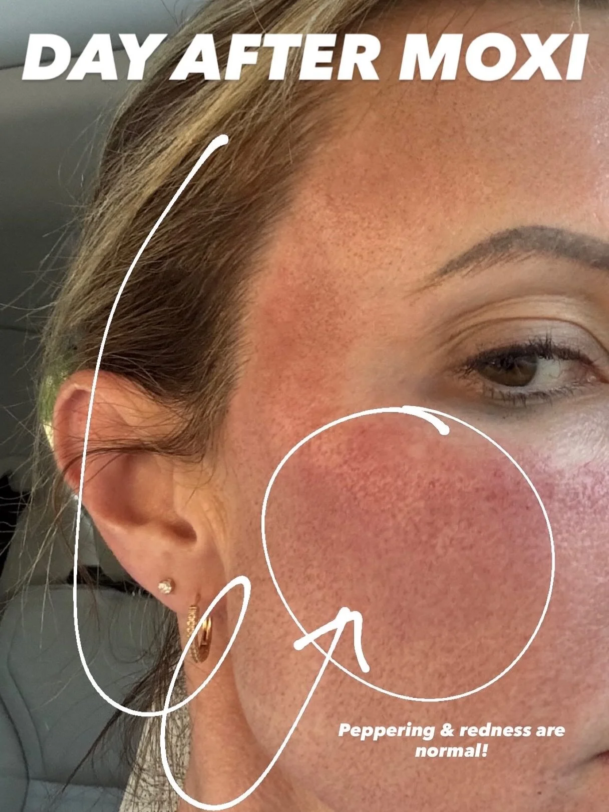What healing looks like in real-time after MOXI 👇

Here is a preview of what the first few days can look like:

DAY 1: Redness + &ldquo;peppering&rdquo; (tiny dark dots where the laser treated pigmentation)
DAY 3: Flaking, dryness, redness, and pepp