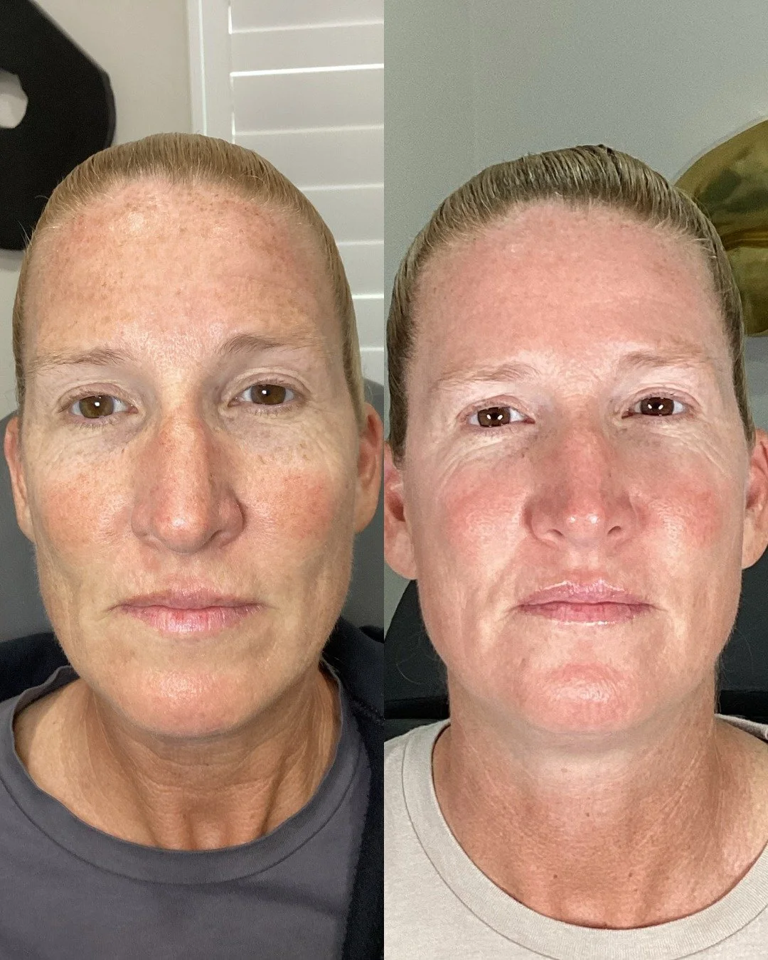 Just ONE treatment and look at that glow ✨
This transformation shows how powerful a single session can be. We&rsquo;re already seeing improvement in tone, texture, and overall radiance&mdash;with even more results to come as the skin continues to hea