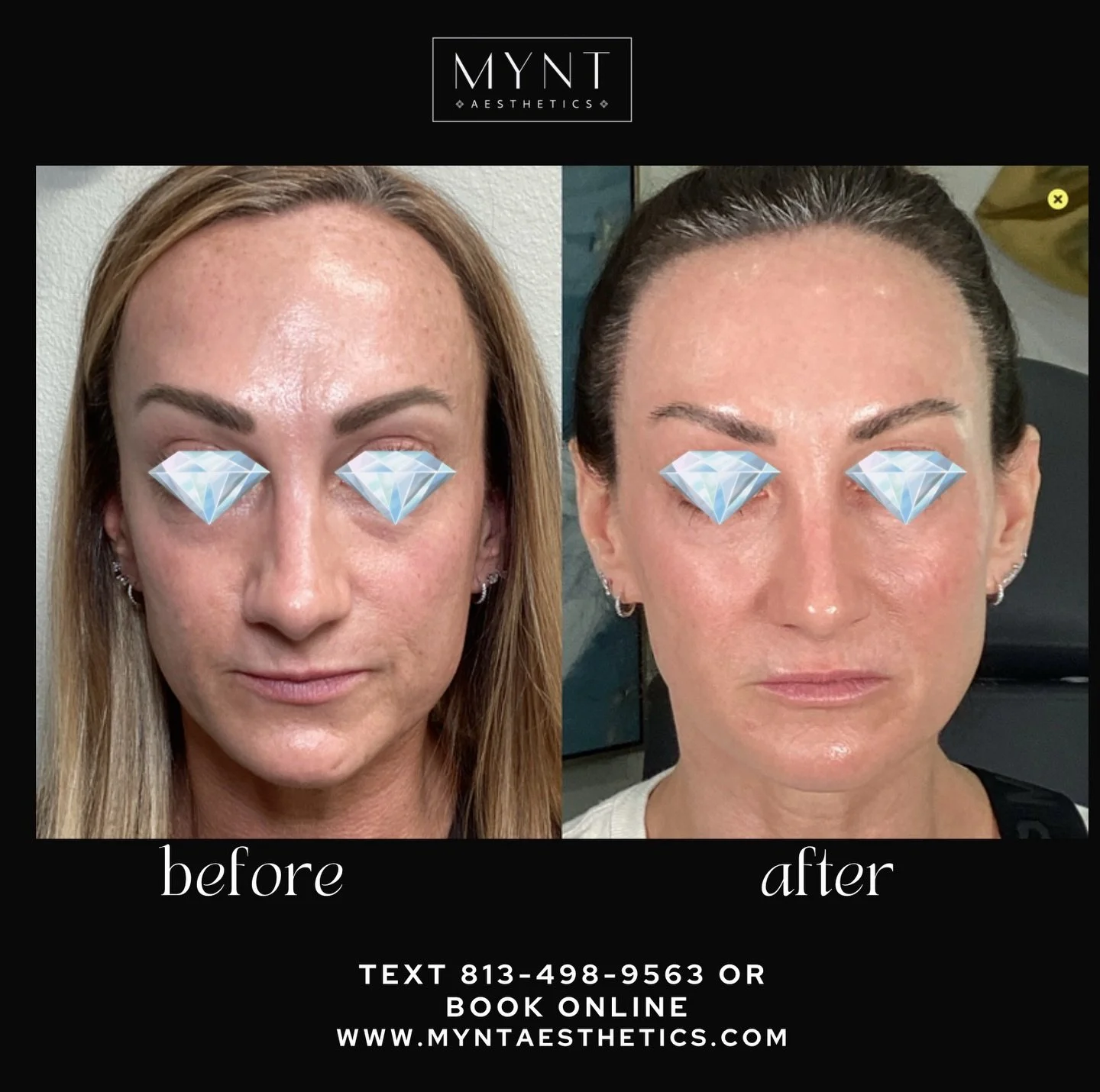 One year. Consistency. Real results ✨ 

She didn&rsquo;t want to look different. She wanted to look like her BEST self. Here are the treatments she did over the past year:
✨ 3 rounds of Sculptra
✨ Consistent Dysport 
✨ Halo resurfacing 
And this is t