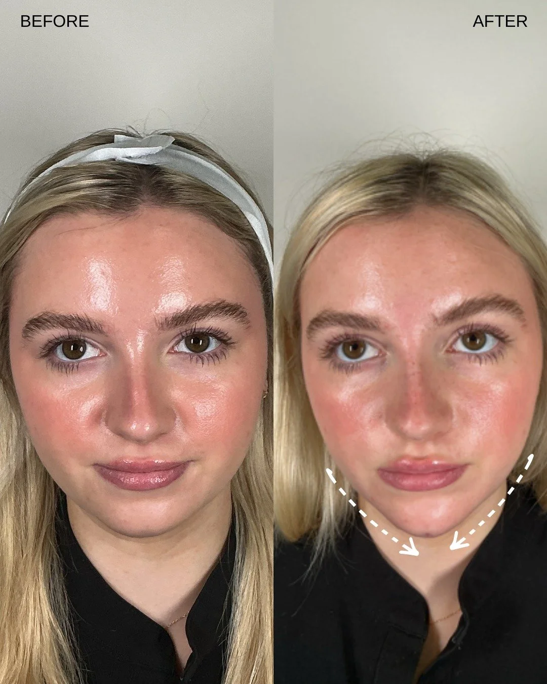 Nose and chin filler are commonly used together to create better facial balance and harmony without surgery. In many cases, a profile may appear unbalanced not because one feature is &ldquo;wrong,&rdquo; but because the proportions between the nose, 