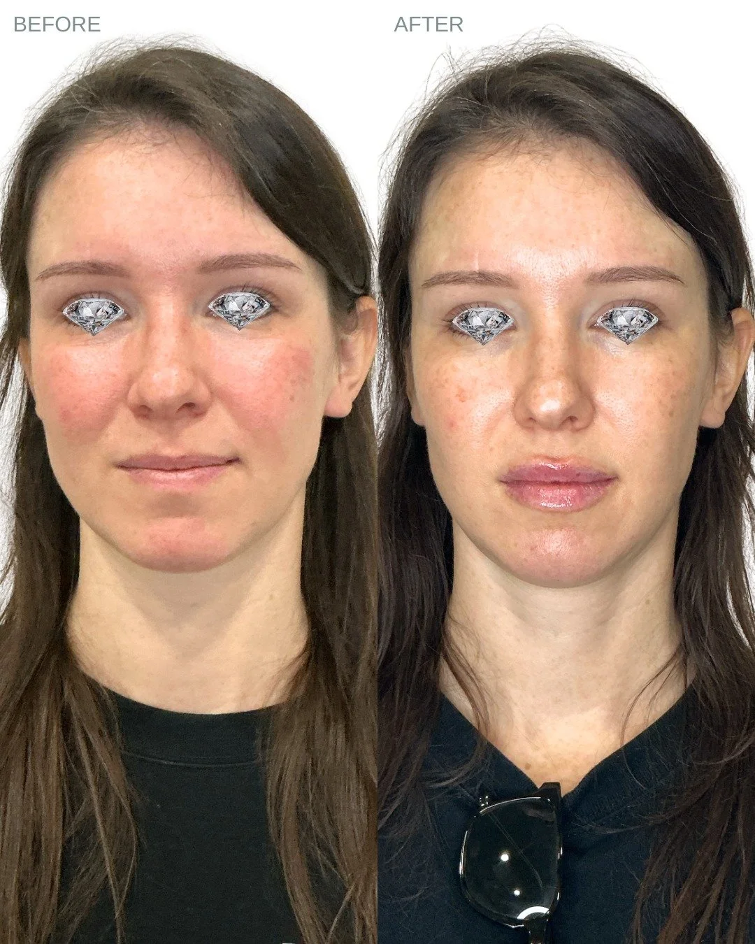 Balanced, hydrated, and naturally enhanced ✨

This transformation was created using 1 syringe of Restylane Kysse strategically placed in the lips and chin to create softer contours, improved profile balance, and a fuller &mdash; yet still natural loo