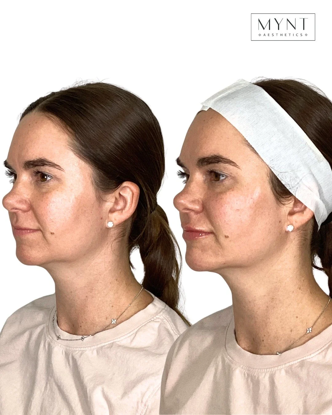 ✨ Why full-face balancing matters ✨

One of the biggest misconceptions about filler is that treating a single area will create the best result. In reality, facial aging affects multiple areas at once&mdash;volume loss, structural changes, and tissue 