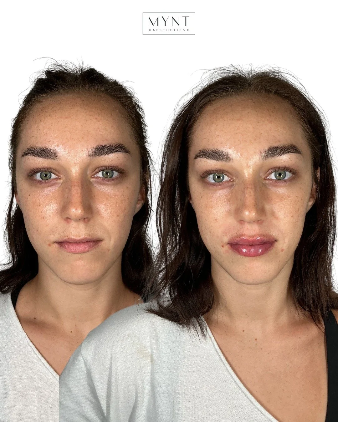 One syringe, beautifully balanced results. ✨

Using just 1 syringe of Restylane Kysse, we enhanced her lips while strategically softening her nasolabial lines for a refreshed, natural look. 
The result? Features that are more defined, harmonious, and