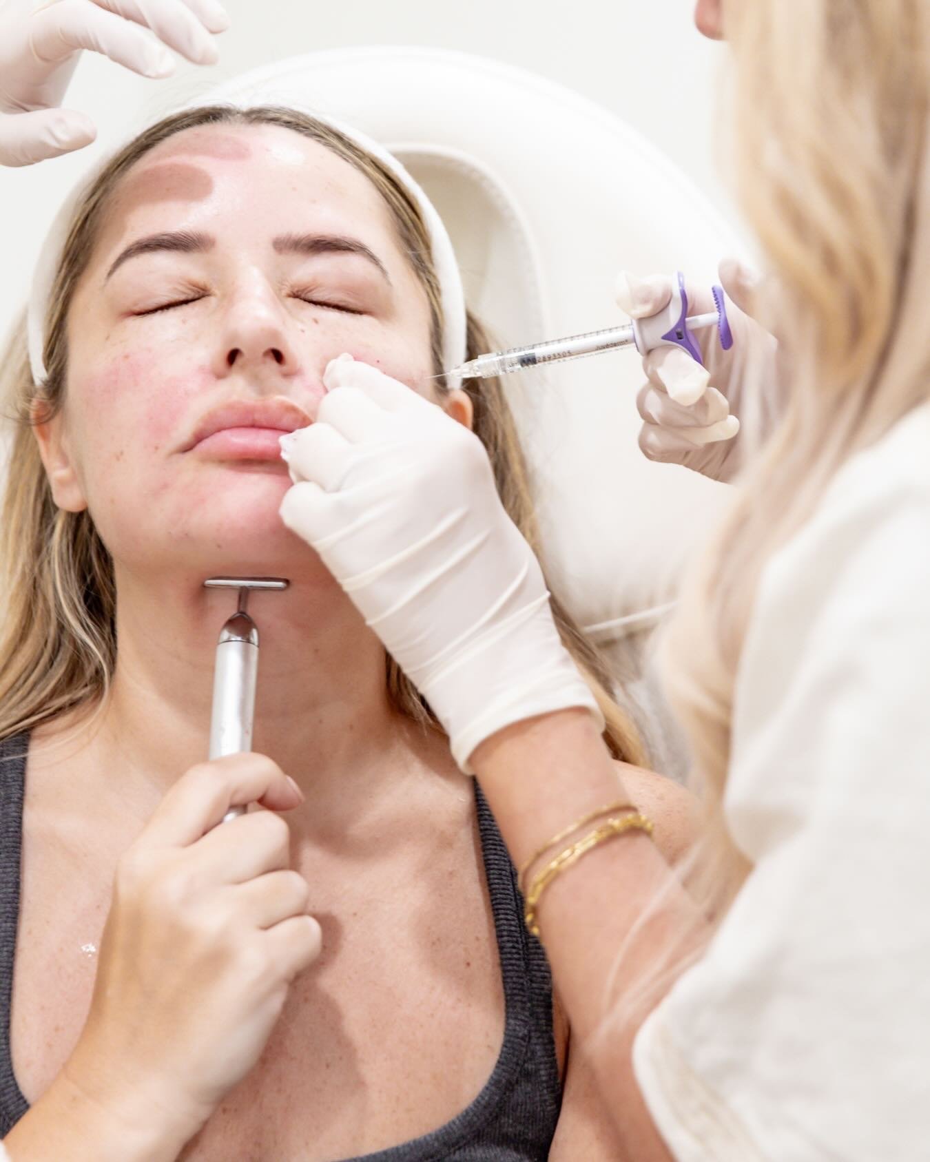 Day 6 of our 12 Days of Christmas - Facial Balancing with Dermal Filler! 
 ✨Our approach at Canvas is rooted in enhancing your natural structure, not changing it.

🎁 Now through Friday - Take advantage of this flash offer - Buy 2 Juvederm Syringes, 