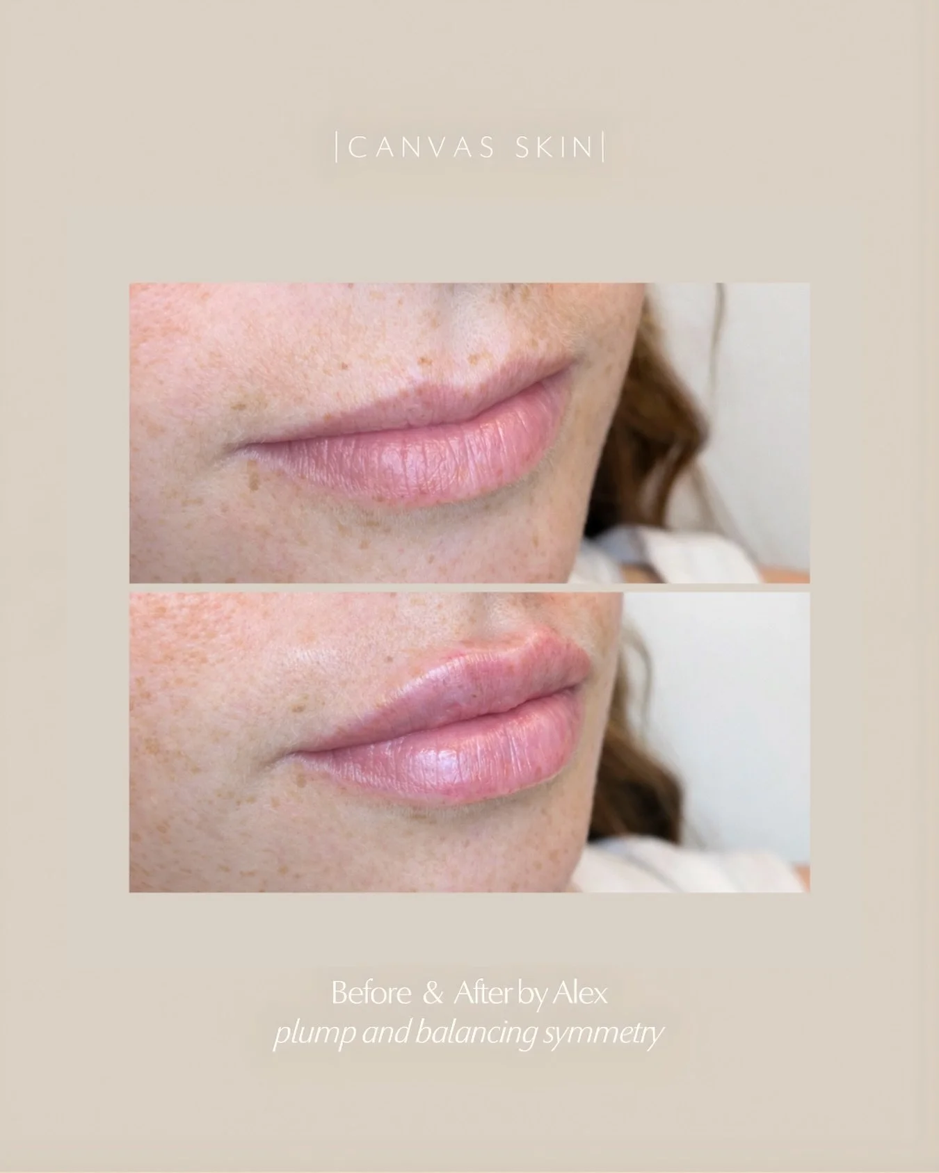 ✨Balanced, plump, and so intentional.
 This is lip filler done the Canvas Skin way&mdash;enhancing shape, restoring balance, and keeping everything beautifully you.

Plump where needed. Balanced where it counts. Results by Alex

📍 Nashville, TN 📲 C