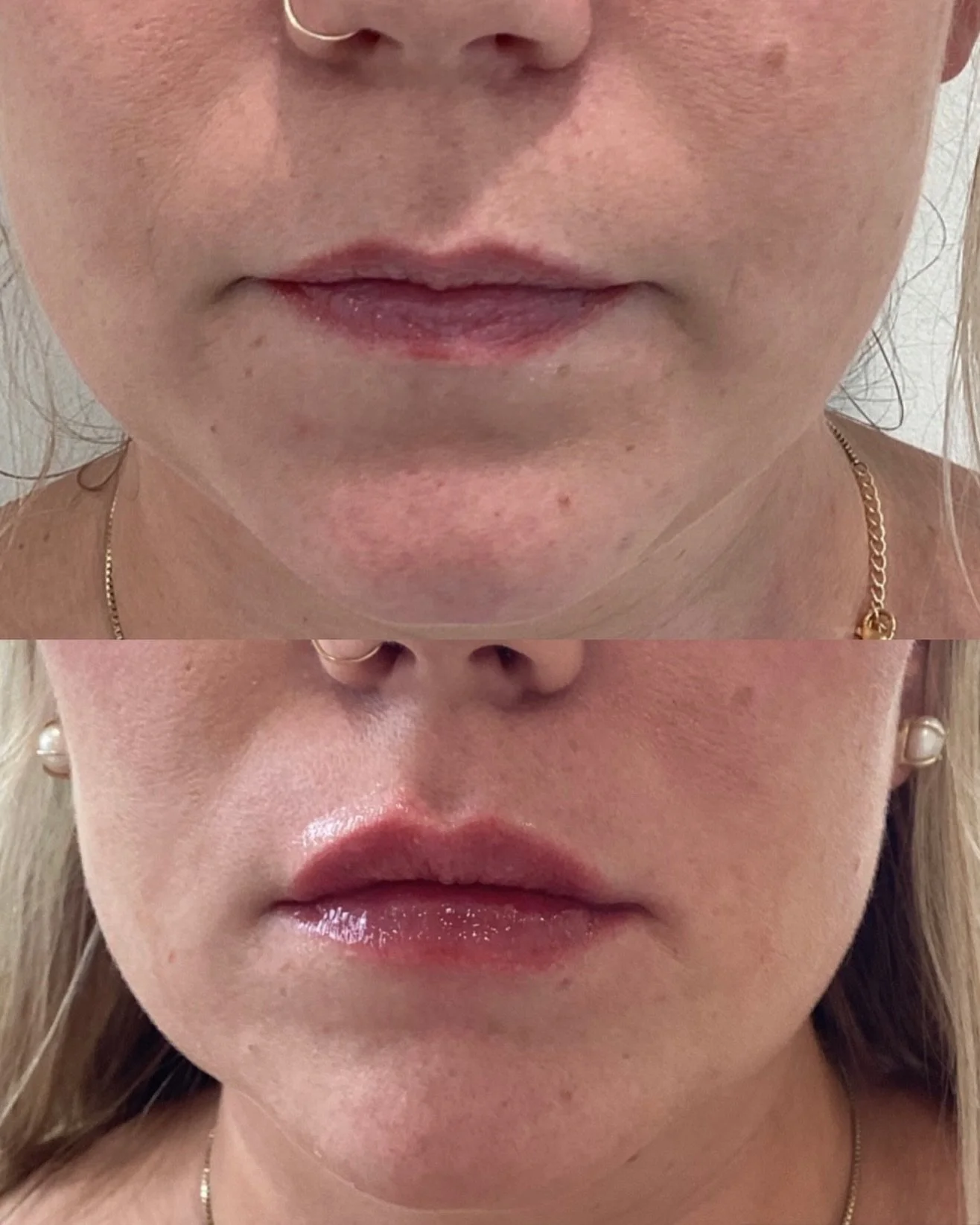 Subtle enhancements. Thoughtfully placed. Comment &ldquo;book&rdquo; to book your personalized lip consultation with Canvas Skin.🤍