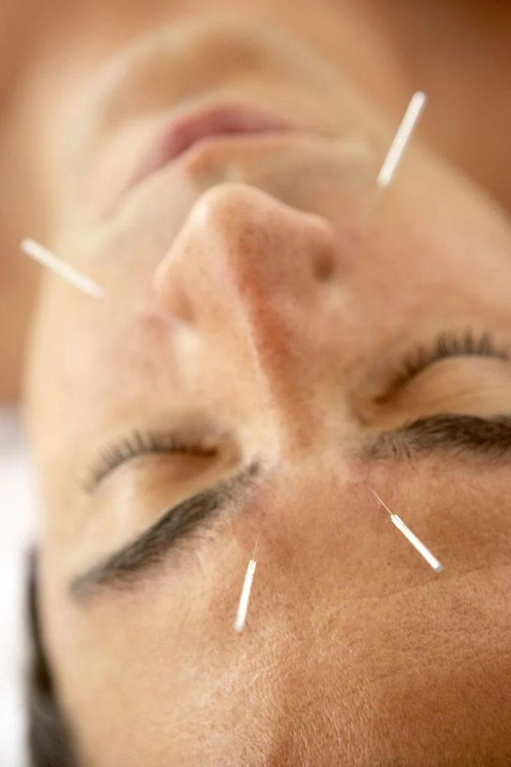 Acupuncture for sinus, nasal congestion, headache, jaw pain, hormonal headaches, TMJ. Available at Beattie Street Health Balmain, Sydney with Melinda Webb.
