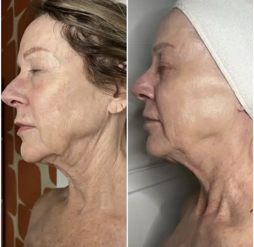 DMK StemZyme Results