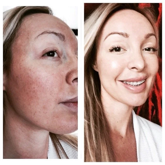 Mid-Depth Skin Peel