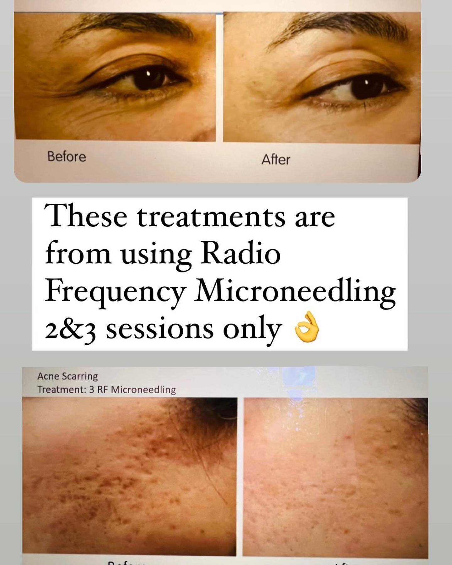 Let&rsquo;s talk Radio Frequency Microneedling this will Improve the texture and appearance of your skin using super fine micro needles and heat. 
Our breakthrough skin tightening microneedling can leave your skin smoother and firmer as well as reduc