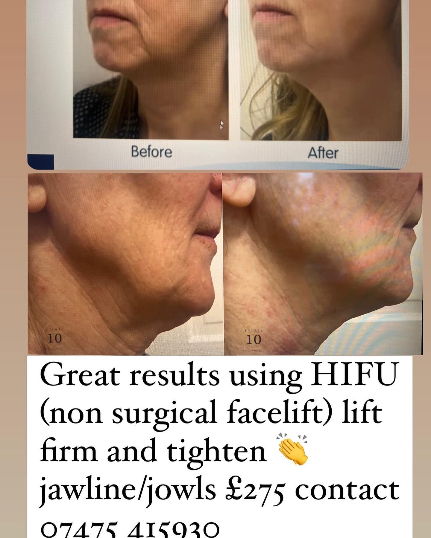 HIFU delivers ultrasound energy below the skin&rsquo;s surface, deep into the superficial musculoaponeurotic system (SMAS) layer, to contract and target all skin layers in one single treatment.

This kick starts collagen regeneration, leaving your sk