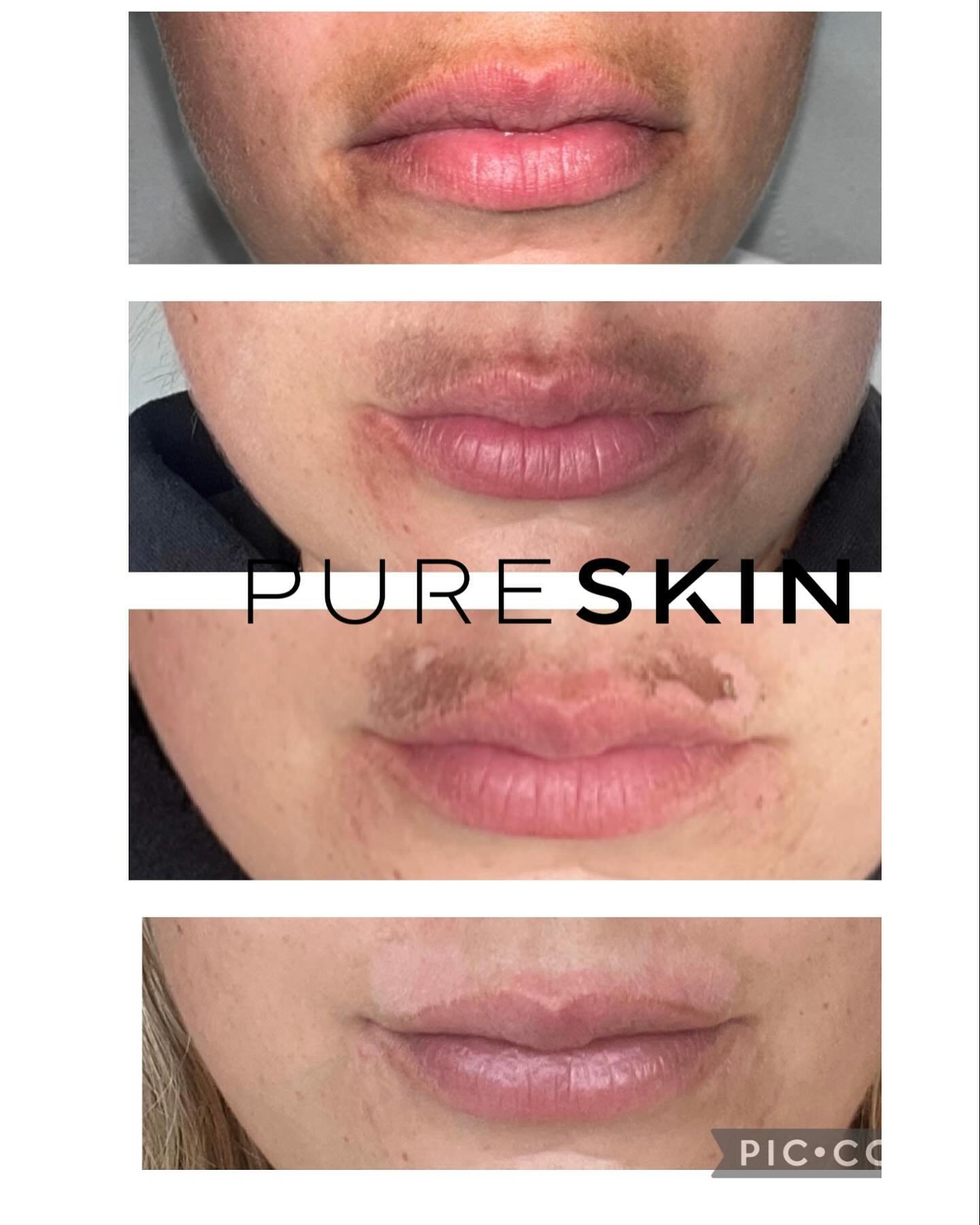 Pigmentation reduction/removal using the Pico pro laser - the most advanced laser technology 🤩
We specialise in the reduction/removal of pigmentation and are so pleased to share these amazing results after only 6 days post treatment. 
We can treat a