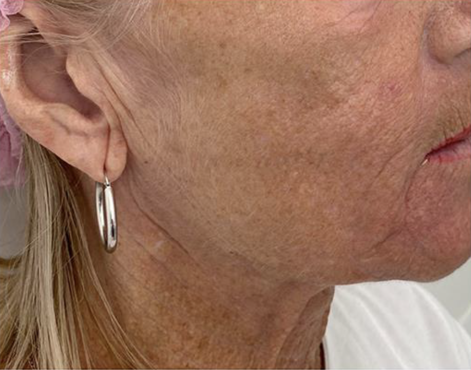 Non+surgical+face+lift+jawline+-+after.png?format=1000w