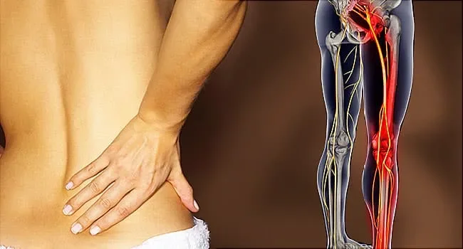 Understanding Sciatica and Why It Affects So Many Limerick Residents