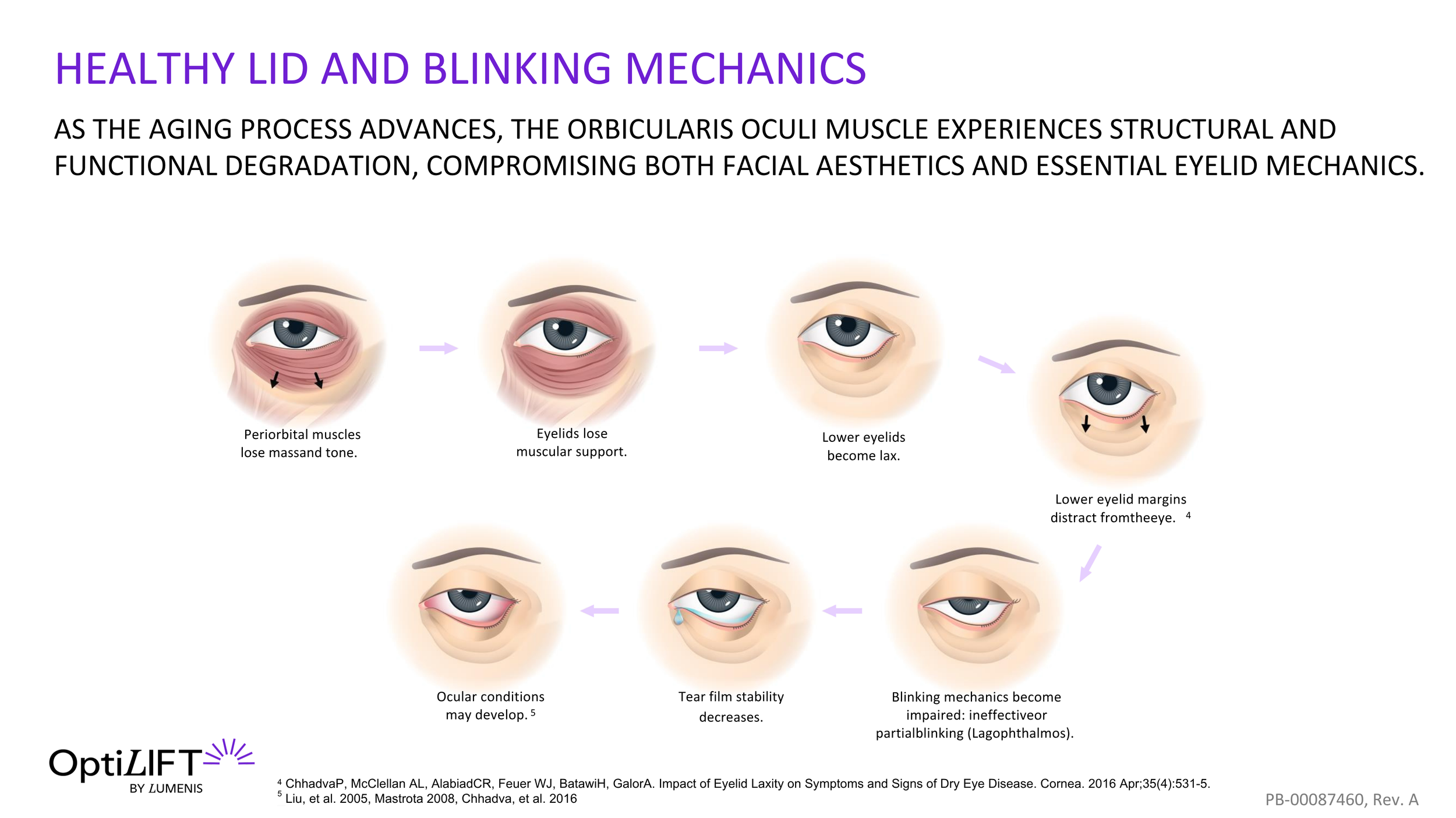 OptiLIFT visual – healthy lid and blinking mechanics