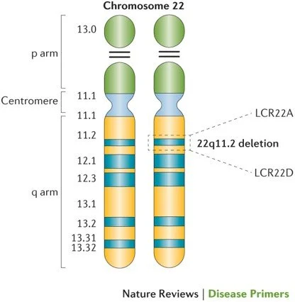 Diagram of chromosome 22q deletion