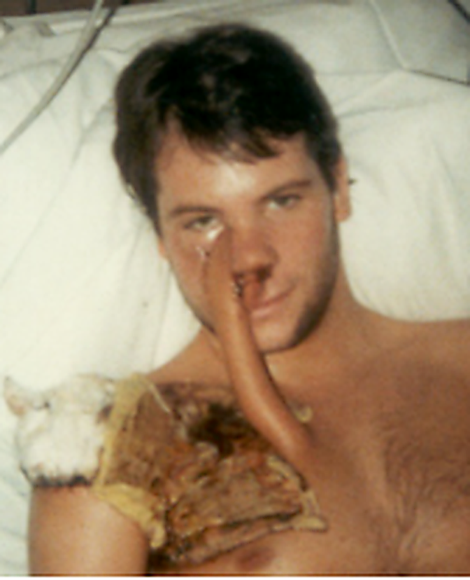 A young man lies in a hospital bed with a medical tube in his nose and visible bandaging and surgical dressing near his shoulder and upper chest.