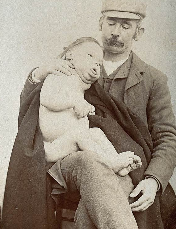 A vintage photo of a father holding his naked son with Down syndrome